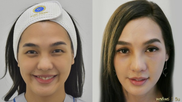 การทำศัลยกรรมตาสองชั้น