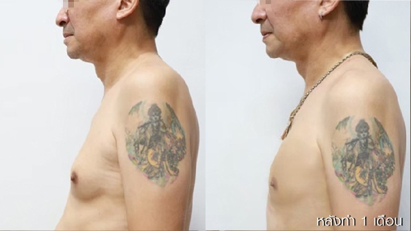 ลดขนาดหน้าอกผู้ชาย