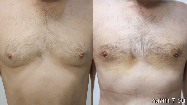 ลดขนาดหน้าอกผู้ชาย