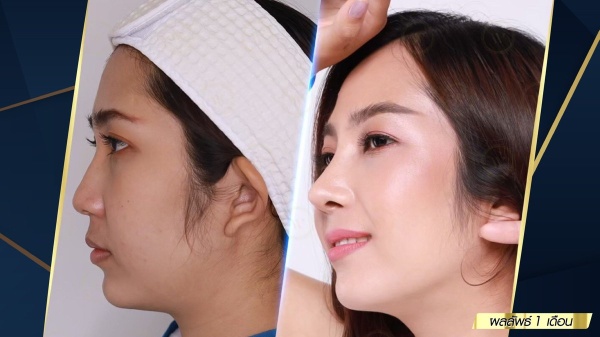 เสริมจมูก