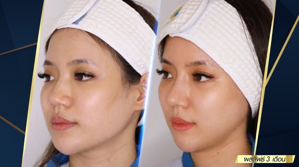 เสริมจมูก