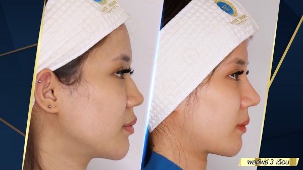 เสริมจมูก