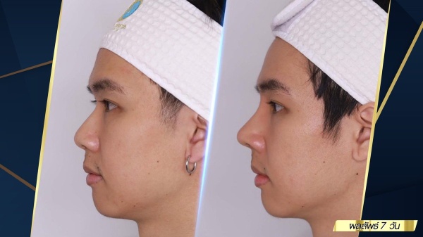 เสริมจมูก