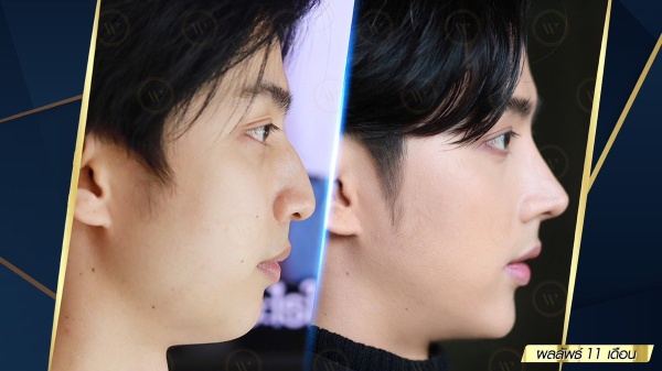 เสริมจมูก