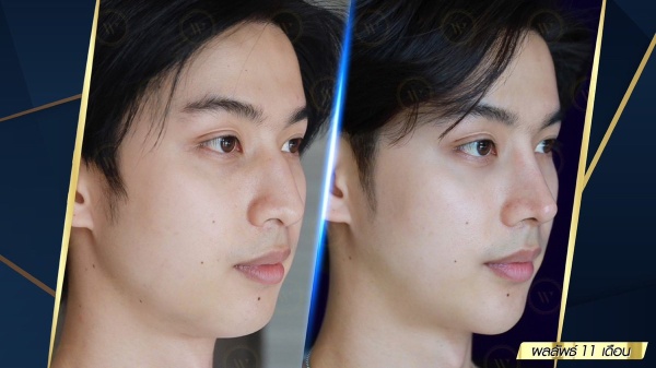 เสริมจมูก