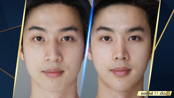 เสริมจมูก