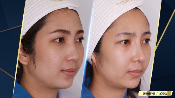 เสริมจมูก