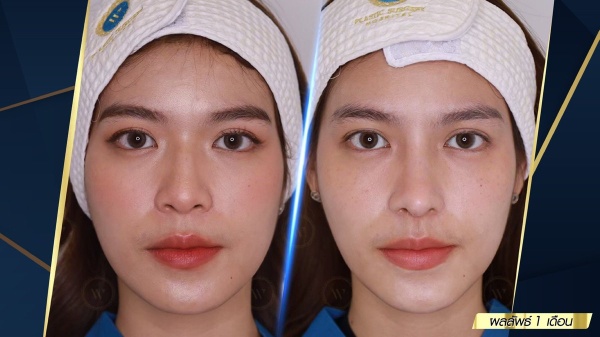 เสริมจมูก