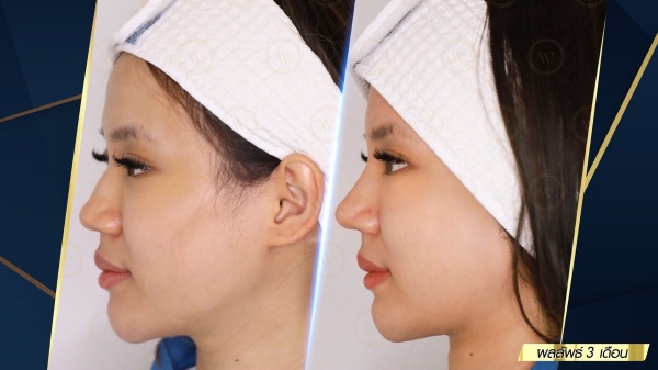 เสริมจมูก