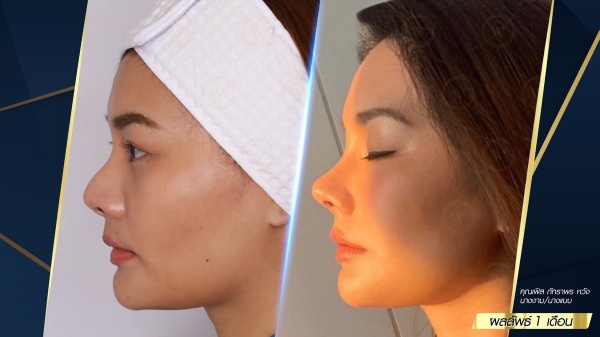 เสริมจมูก