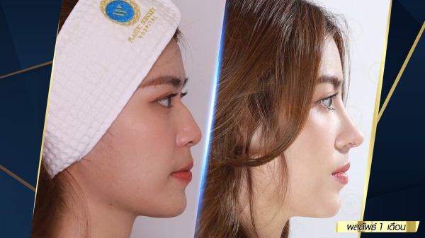 เสริมจมูก