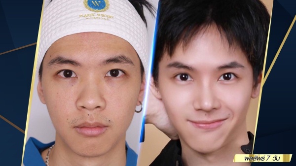 เสริมจมูก