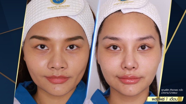 เสริมจมูก