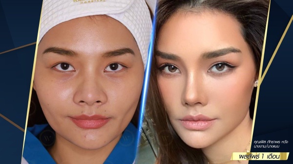 เสริมจมูก