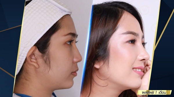 เสริมจมูก