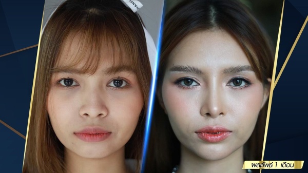 เสริมจมูก