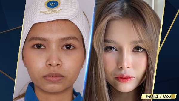 เสริมจมูก