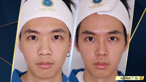 เสริมจมูก