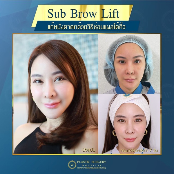 หนังตา/หางตาบนตก