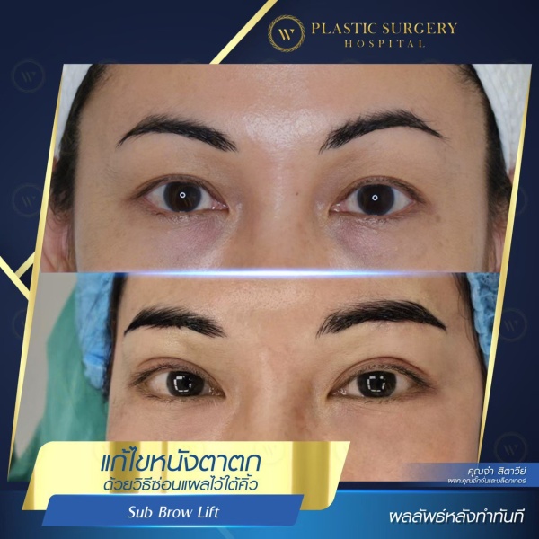 หนังตา/หางตาบนตก