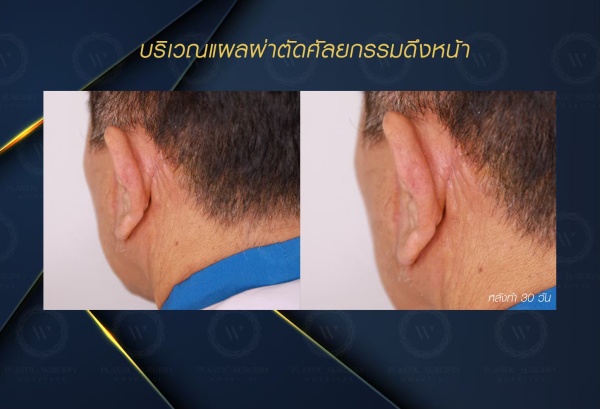 ดึงหน้า