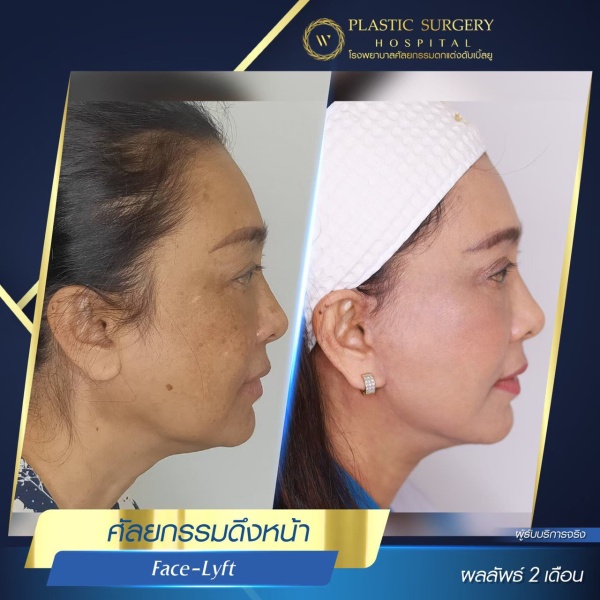 ดึงหน้า