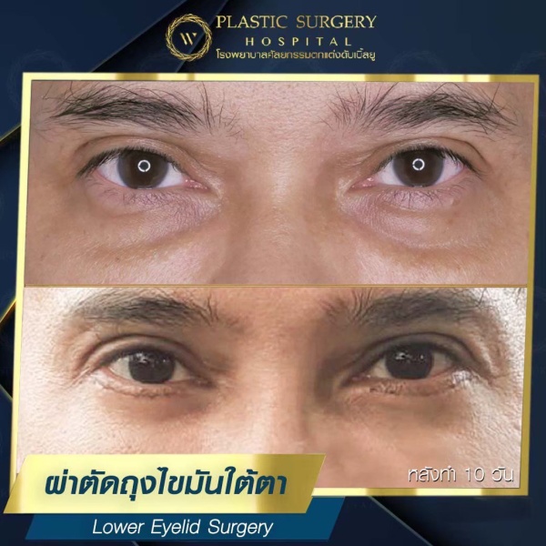 ตัดถุงไขมันใต้ตา