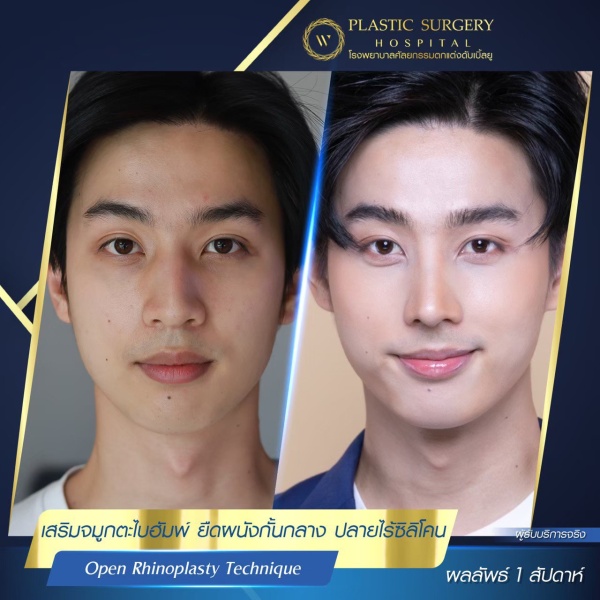 เสริมจมูก