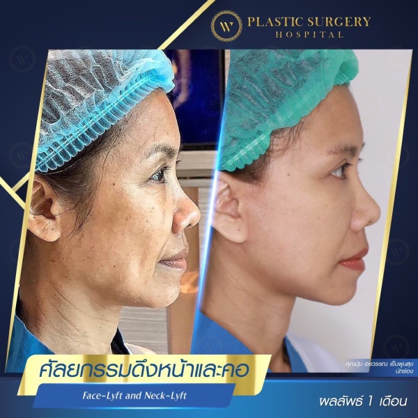 ดึงหน้า