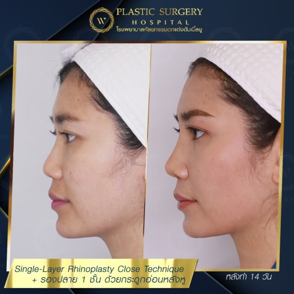 เสริมจมูก