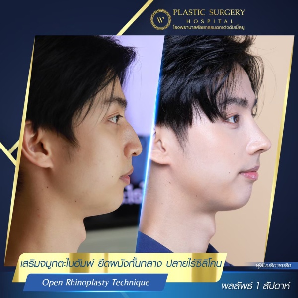 เสริมจมูก