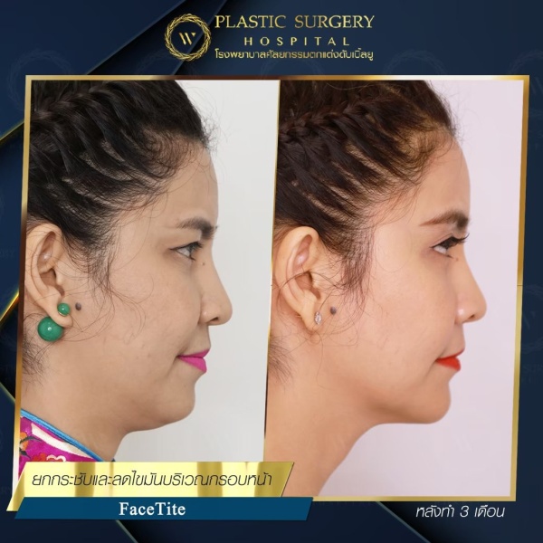 ดูดไขมันเหนียงใต้คาง (FaceTite)