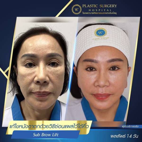 หนังตา/หางตาบนตก