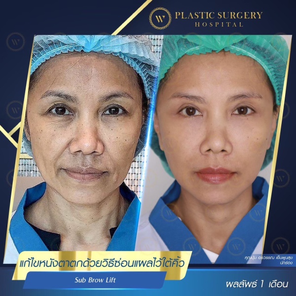 ศัลยกรรมแก้ไขปัญหาหนังตา