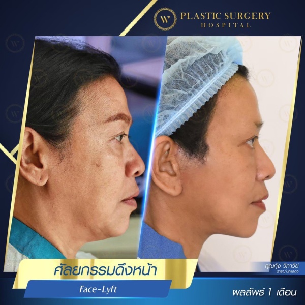 ดึงหน้า