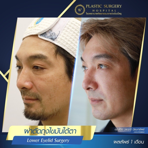 Lower Eyelid Surgery