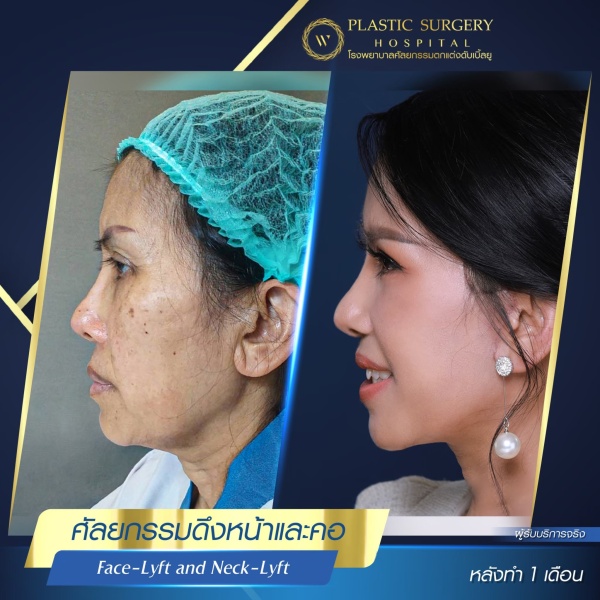 ดึงหน้า