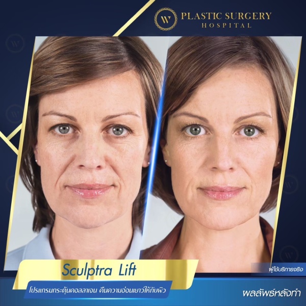 Sculptra Lift