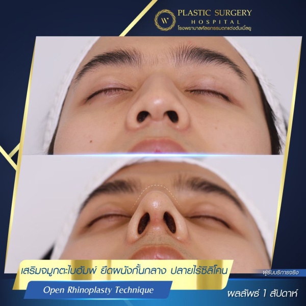 เสริมจมูก