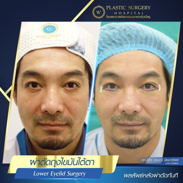 Lower Eyelid Surgery