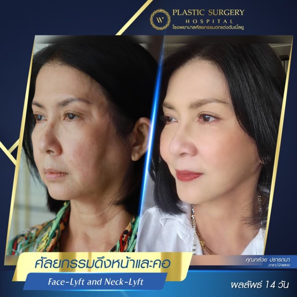 ดึงหน้า