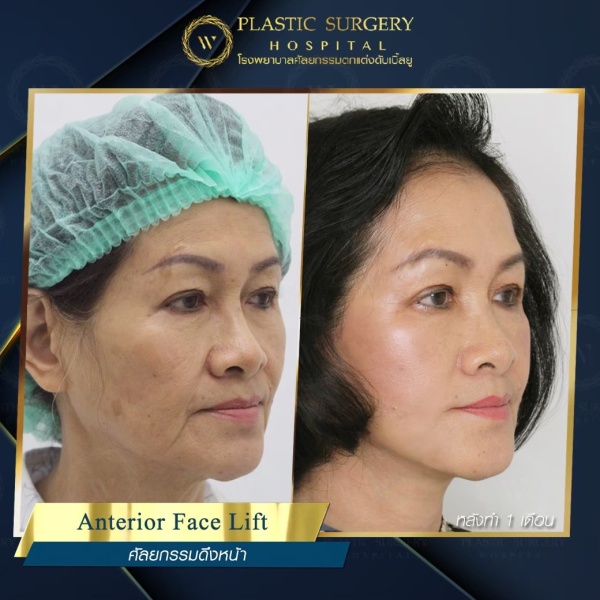 ดึงหน้า