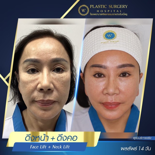 ดึงหน้า