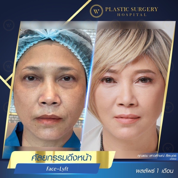 ดึงหน้า