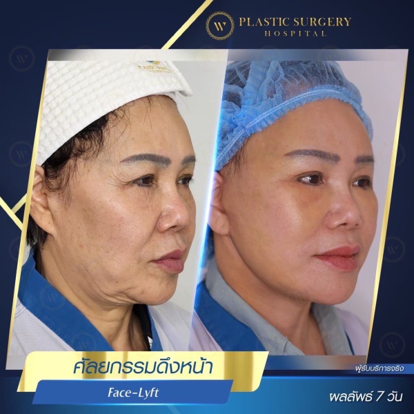 ดึงหน้า