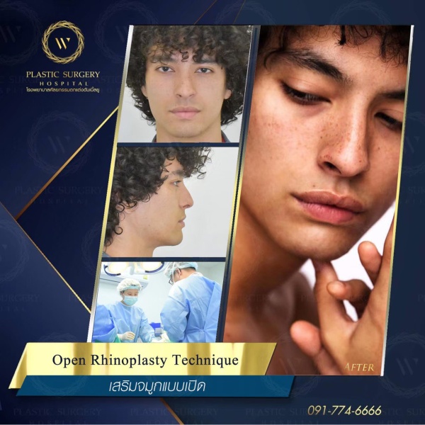 เสริมจมูก