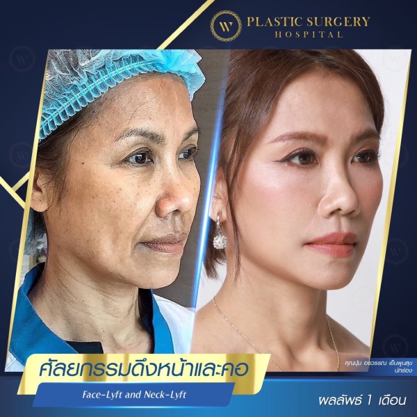 ดึงหน้า