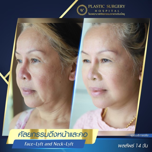 ดึงหน้า