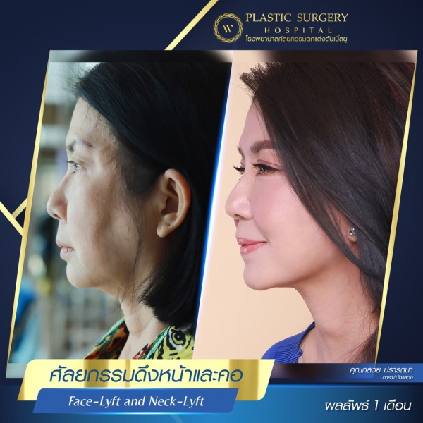 ดึงหน้า