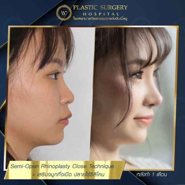 เสริมจมูก